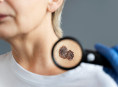 Commonest Sites for Skin Tags