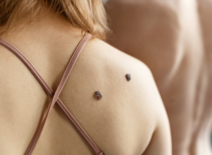 Skin Tags